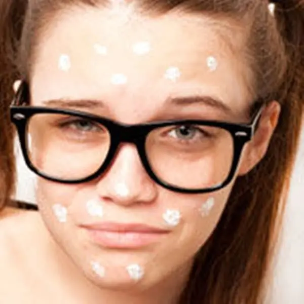 get-rid-of-pimples-toothpaste