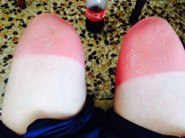 sunburn legs