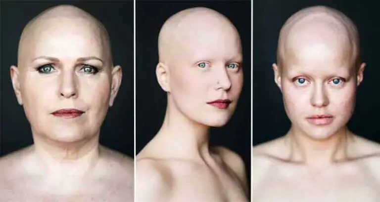 Photographer Captures Beauty Of Bald Women
