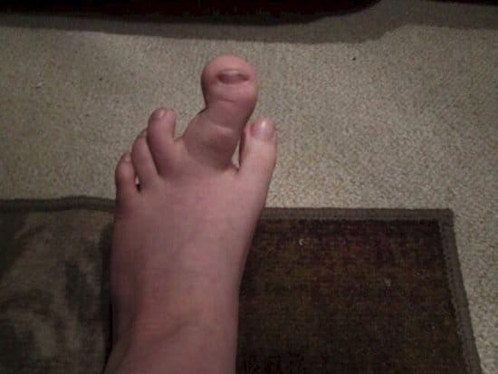 bad-toe