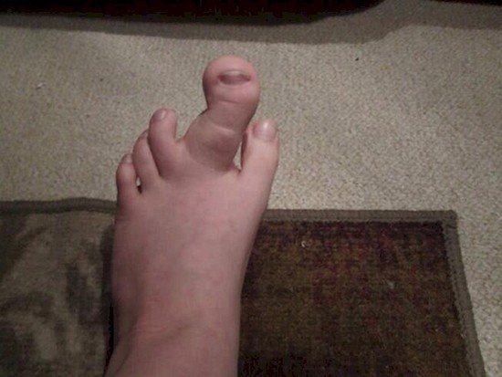 badly swollen toe