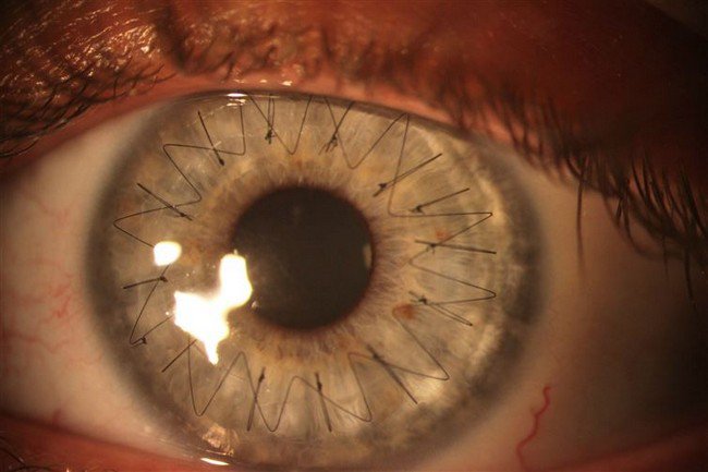 cornea transplant