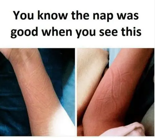 photos of arms with marks from napping