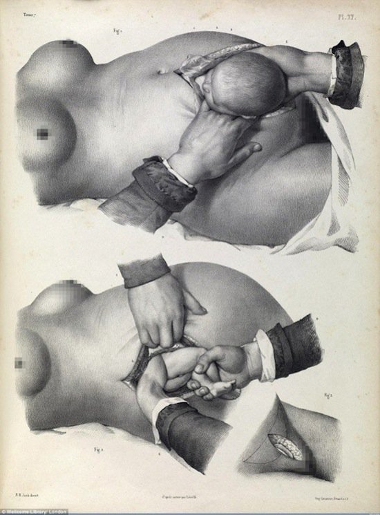 medical-cesarean