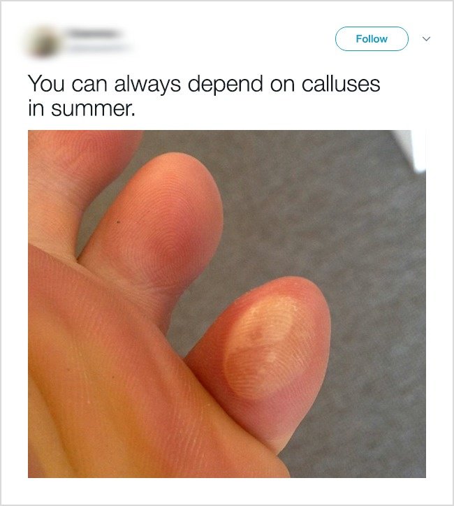 Annoying Things Girls Experience During Hot Weather calluses