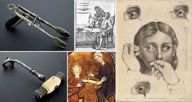 Freaky Surgical Procedures That You'll Be Glad Are No Longer In Use
