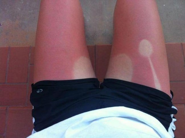 legs_sunburn_fail