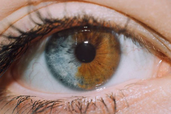 heterochromia iridis