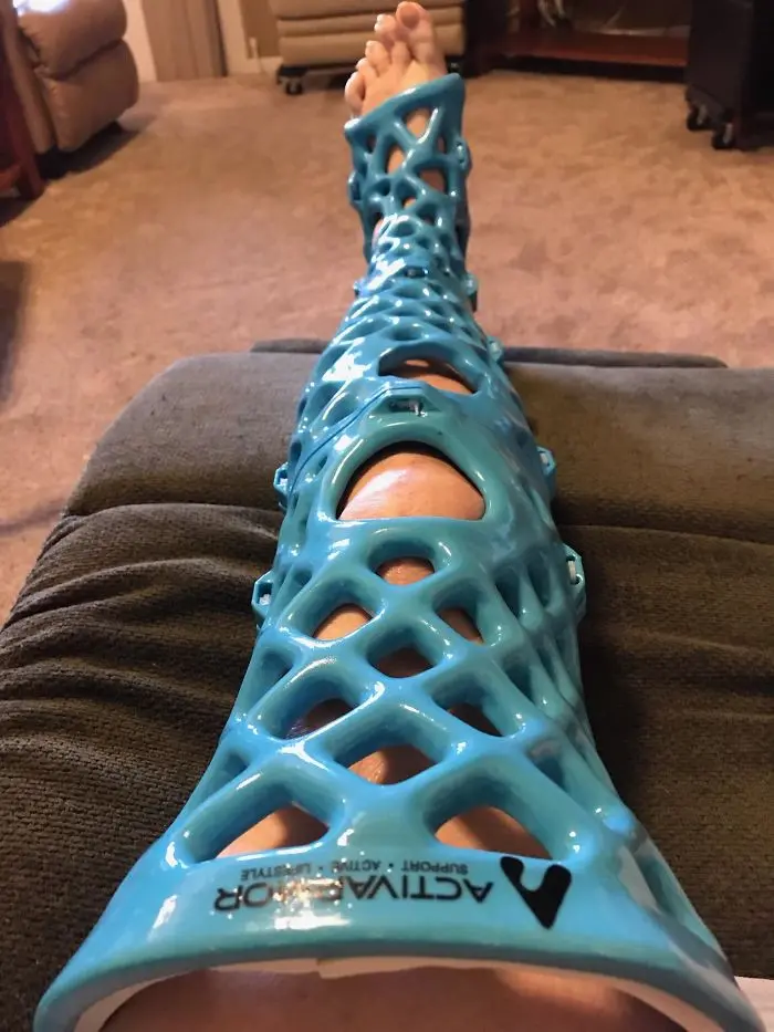 3d printing brilliant creations leg cast