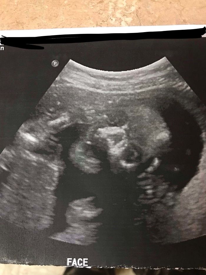 scary harmless things ultrasound photo