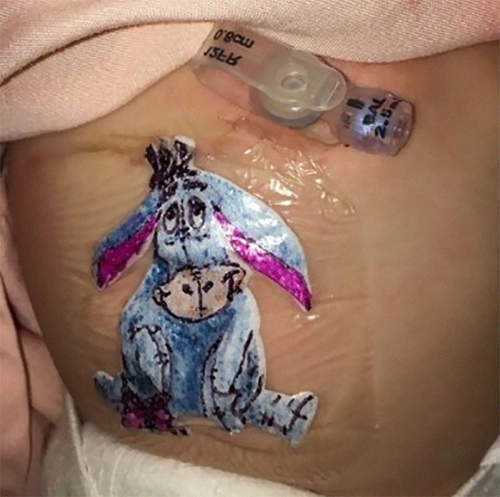 Dr. Robert Parry drew Eeyore on a child's post-op dressing