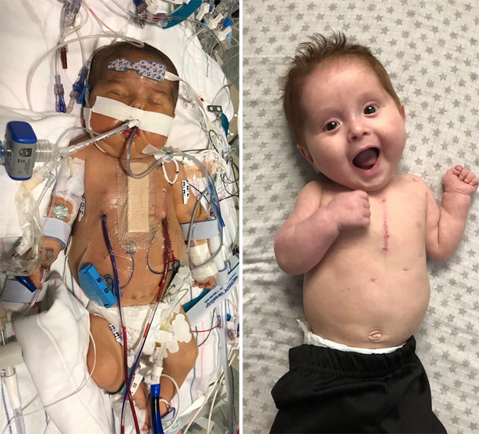 baby with heart defect recovers