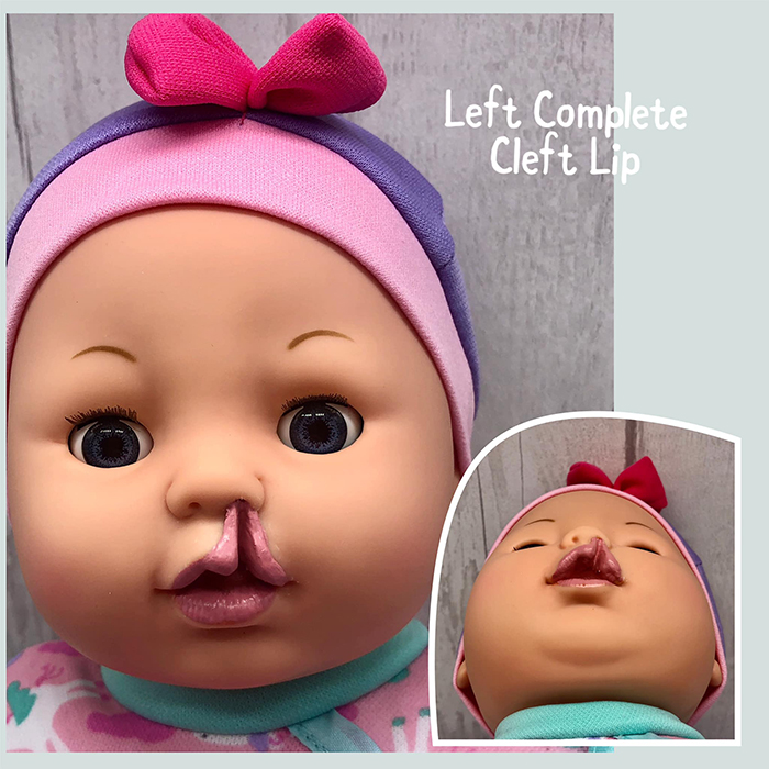 baby doll wearing pink headband with left complete cleft lip