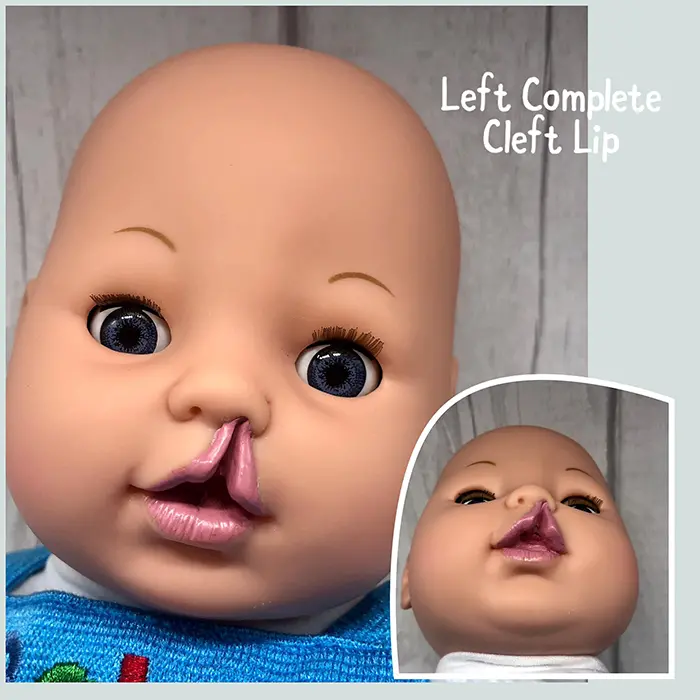 baby doll with left complete cleft lip