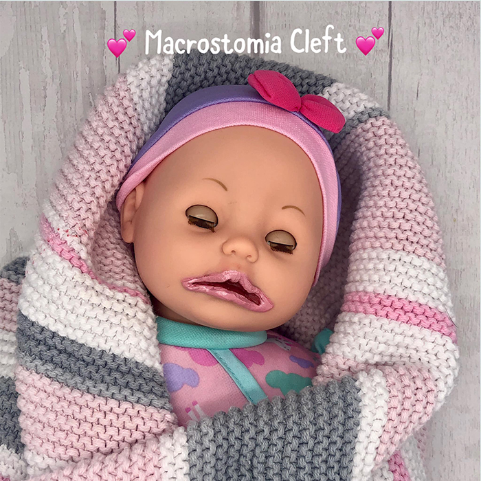 baby doll with macrostomia cleft