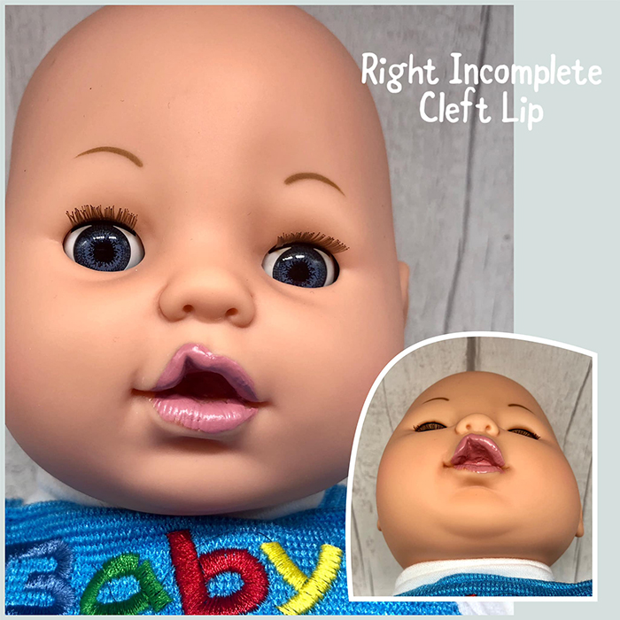 baby doll with right incomplete cleft lip