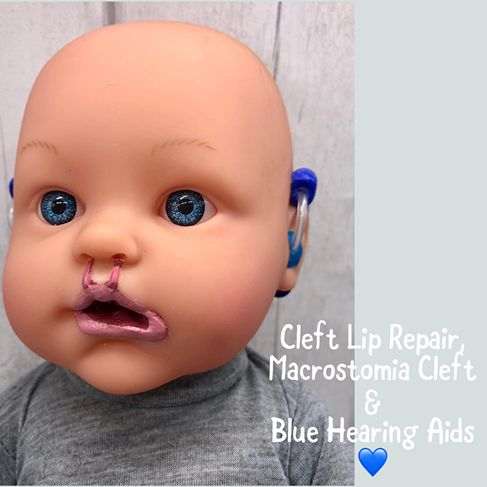 baby toy figure with cleft lip repair, macrostomia cleft, and blue hearing aids