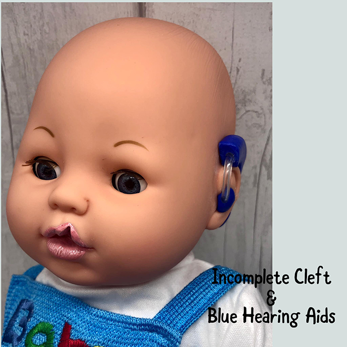 baby toy figure with incomplete cleft and blue hearing aids