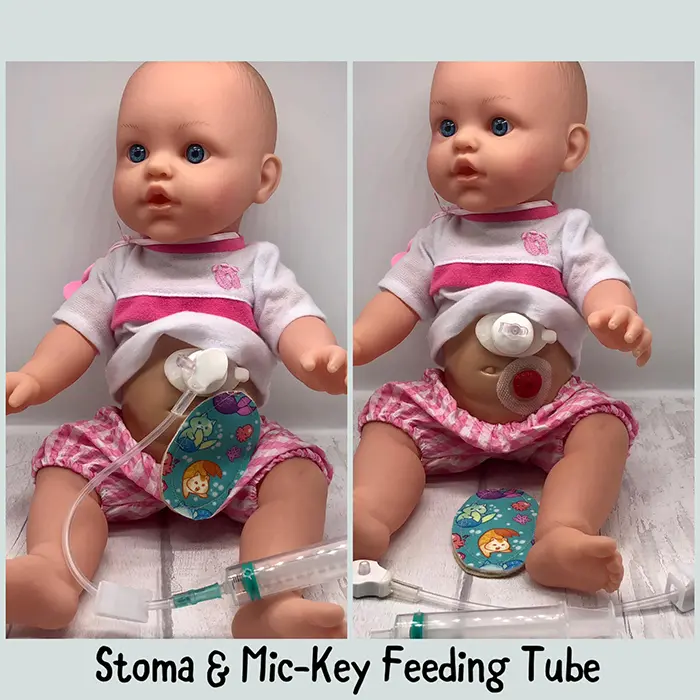 baby toy figure with stoma and mic-key feeding tube