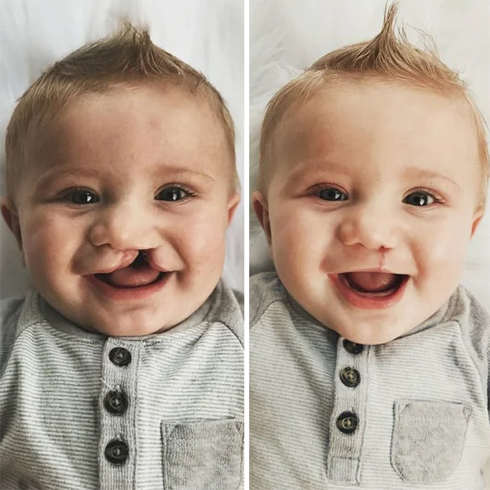 cleft palate surgery baby recovery