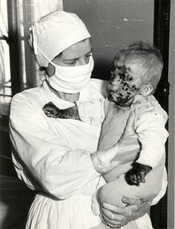 nurse holding a child with smallpox