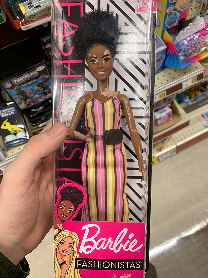 barbie doll skin vitiligo