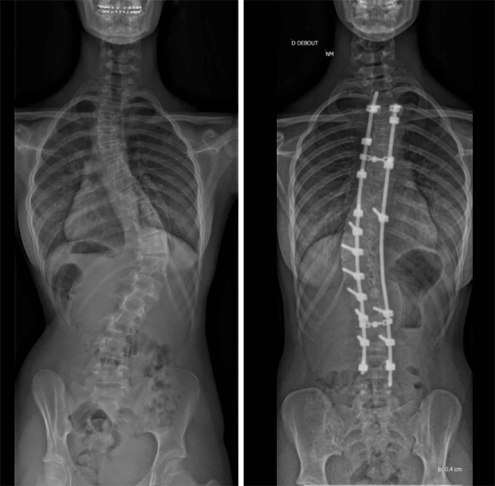 comparison images before and after spine surgery