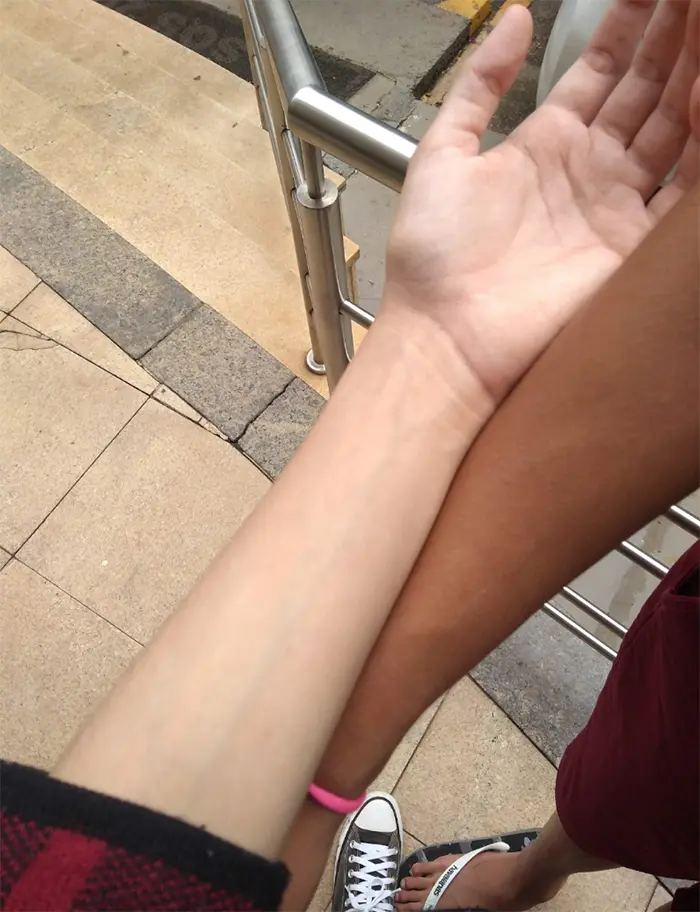 twin skin color difference