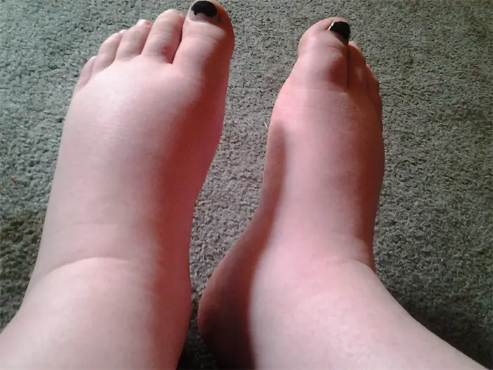 pregnancy problems swollen feet
