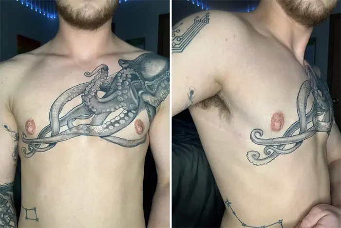 clever tattooing over postop scar