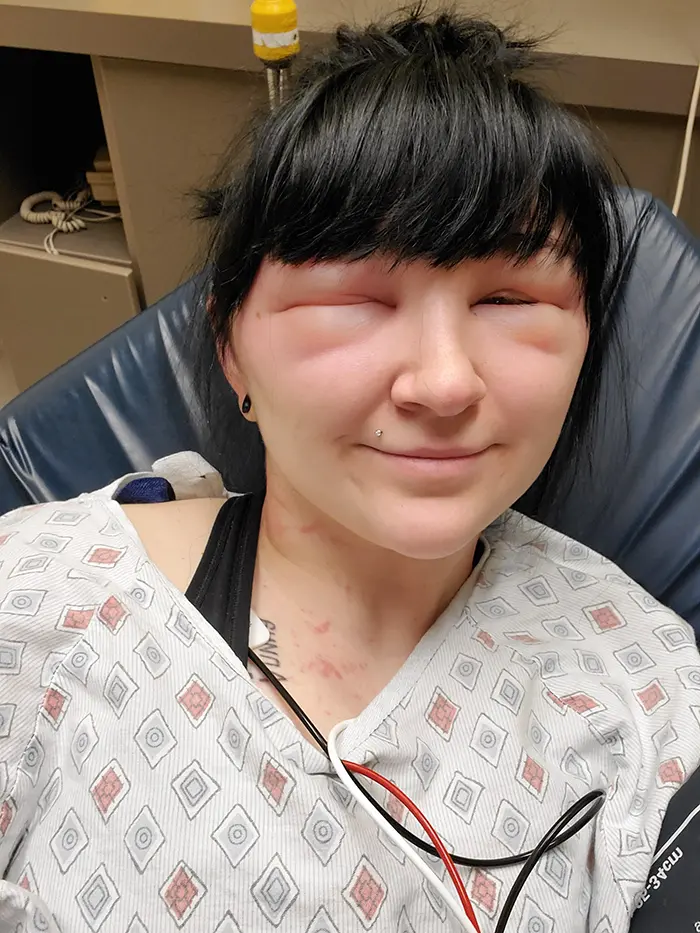 girl severe allergic reaction to hair dye